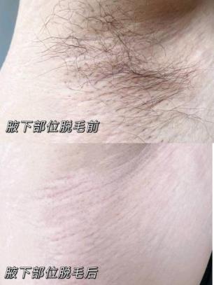 薇婷脱毛膏会使毛越来越粗吗？真相是这样的