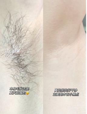 薇婷脱毛膏使用方法腋下脱毛很方便