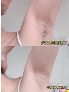 每日一问：用脱毛膏脱毛会不会越长越粗