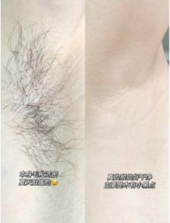 使用薇婷脱毛膏会使毛越来越粗吗