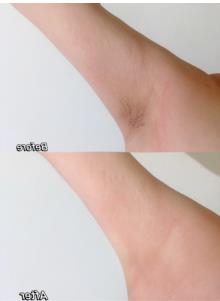 薇婷脱毛膏可以脱哪些部位呢，怎么样