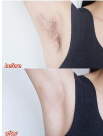 关于腋下脱毛的最佳方法你了解多少