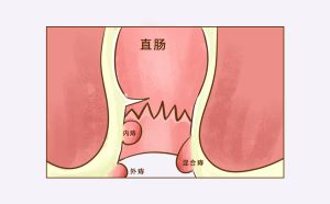 “痔”来敲门：什么药治痔疮效果好