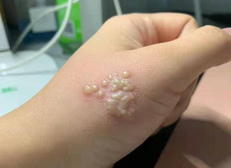 男子拍死隐翅虫多处溃烂5天未愈?京万红来支招了