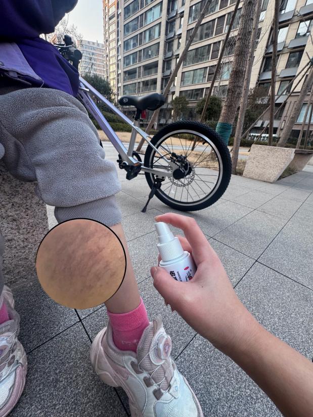 小腿拉伤肿胀一般要多久才会消？