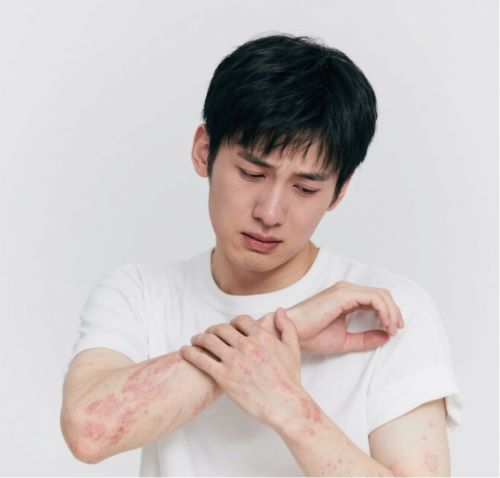 芙美松糠酸莫米松治疗皮炎湿疹的优缺点大揭秘！