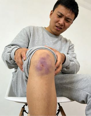 伤科灵喷雾剂可以止痛吗？