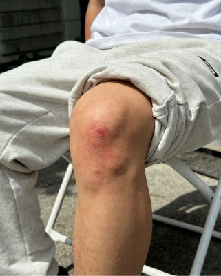 膝关节软组织损伤多久能恢复？