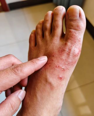 脚上湿疹很痒怎么办？