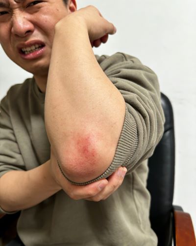 胳膊软组织损伤多久能好？