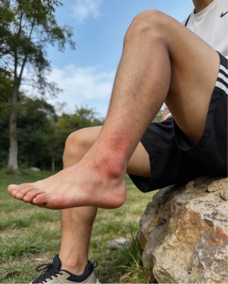 伤科灵能治疗扭伤吗？